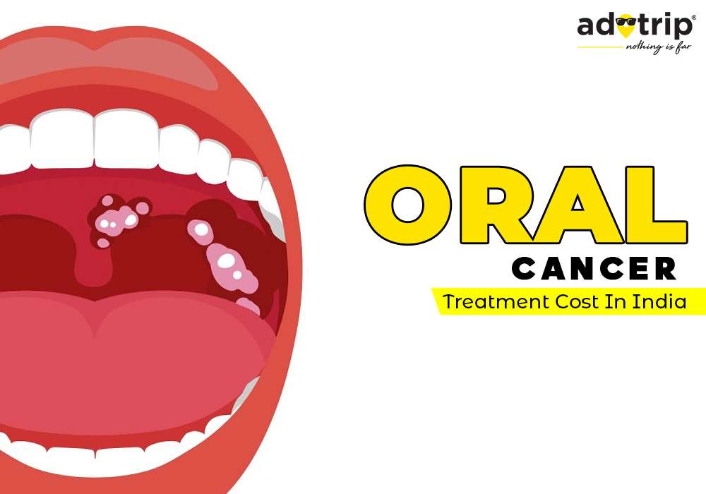 oral cancer treatment cost in india